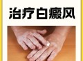 白癜风非物质文化遗产（白癜风非遗疗法靠谱吗）