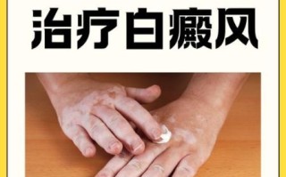 白癜风非物质文化遗产（白癜风非遗疗法靠谱吗）