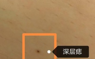 非物质文化遗产点痣（非物质文化遗产点痣合法吗）