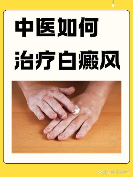 白癜风非物质文化遗产(白癜风非遗疗法靠谱吗)-第1张图片-八三百科 白癜风非物质文化遗产(白癜风非遗疗法靠谱吗)-第1张图片-八三百科