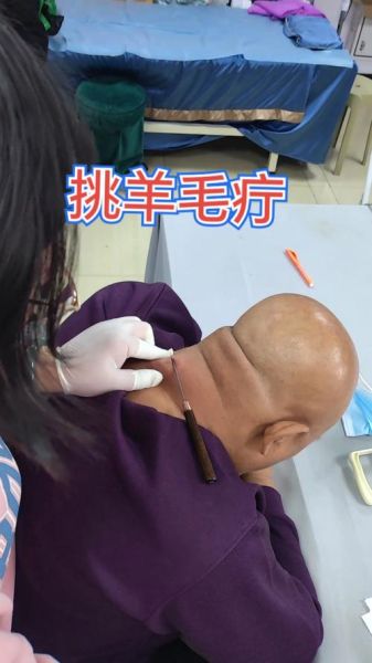 挑羊毛疔非物质文化遗产(挑羊毛疔是国家级非遗吗)-第2张图片-八三百科 挑羊毛疔非物质文化遗产(挑羊毛疔是国家级非遗吗)-第2张图片-八三百科