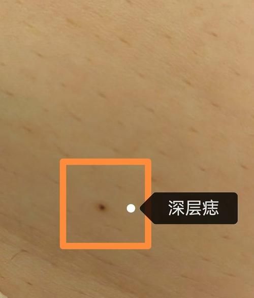 非物质文化遗产点痣（非物质文化遗产点痣合法吗）-第1张图片-八三百科