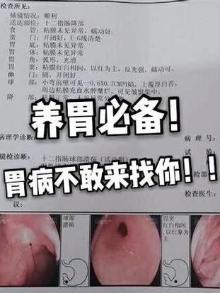 非物质文化遗产胃炎（非物质文化遗产胃炎到底是什么病）-第3张图片-八三百科