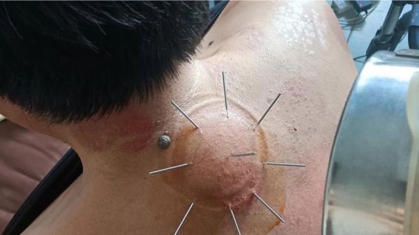 包头非物质文化遗产针灸(包头非遗针灸哪几招治未病最常用)-第2张图片-八三百科 包头非物质文化遗产针灸(包头非遗针灸哪几招治未病最常用)-第2张图片-八三百科