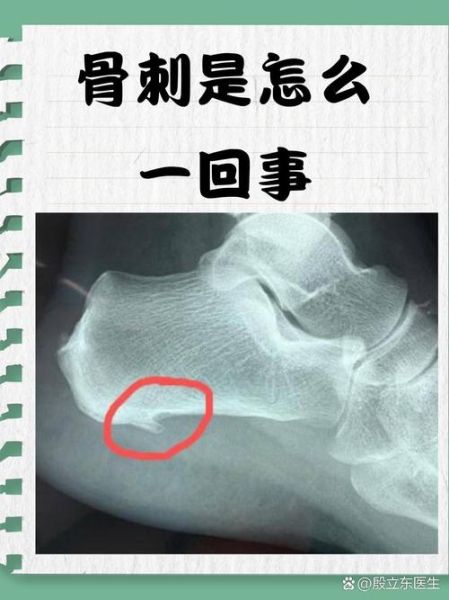 非物质文化遗产 骨刺（骨刺能不能申请非物质文化遗产？）-第3张图片-八三百科